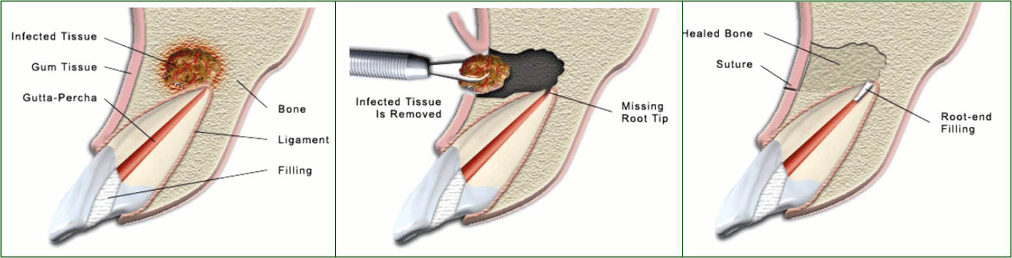 Apicoectomy Downtown London