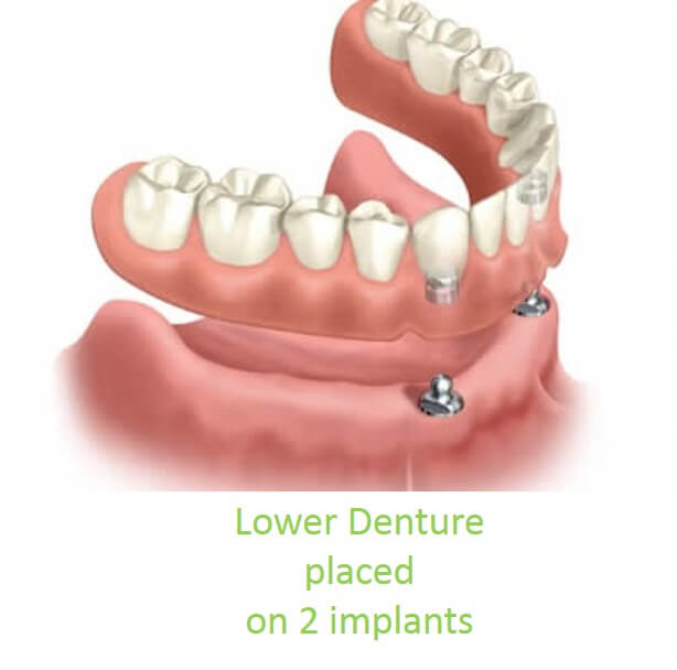 Denture over Implants Central London