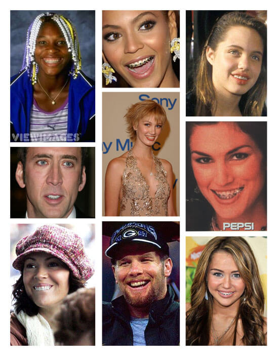 Celebrities with Dental Braces