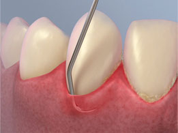 Root Planning Central London