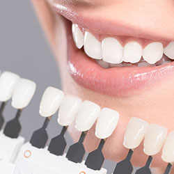 DENTAL VENEERS Victoriapark Dental