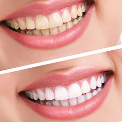 TEETH WHITENING TREATMENT Victoriapark Dental
